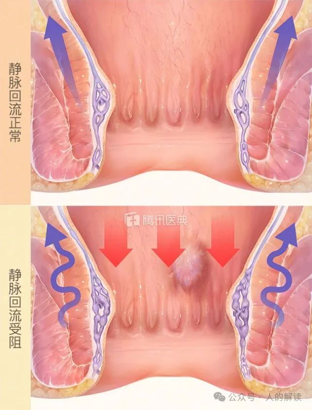 肛门的奥秘，有痣青年的福音